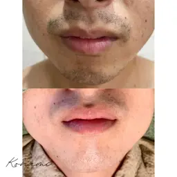 【メンズ光脱毛】髭全体