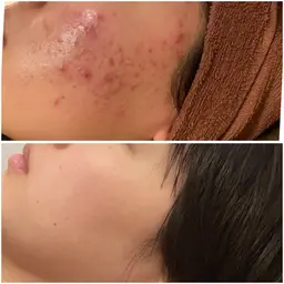 【年末ご褒美SALE⛄️】肌の大掃除🧹✨イオンの力で肌細胞活性化◎ピーリング・温熱パックでニキビなしの赤ちゃん肌に♡