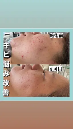 ハーブピーリング