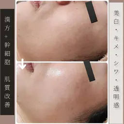 【憧れのツルツル陶器肌】剥離なし肌質改善ハーブピーリング