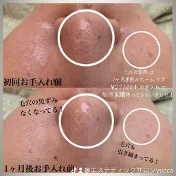 【人気No. 1】集中毛穴ケア 陶器肌・ノーファンデフェイシャル90分¥16500→7500