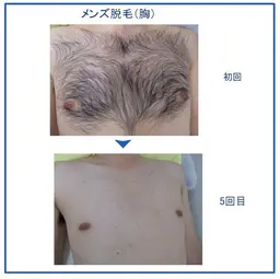 平日限定！定価7500円のところmen'sヒゲ脱毛3パーツ1900円