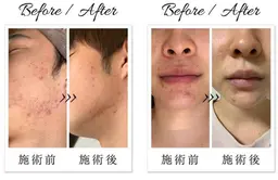 ミニモ限定！人気No. 1肌質改善フェイシャル💆‍♀️