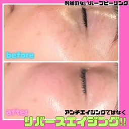 【最先端美容液✨】エイジングケアではなくリバースエイジングケア🪄剥離のないハーブピーリング！あらゆる肌悩みに♡