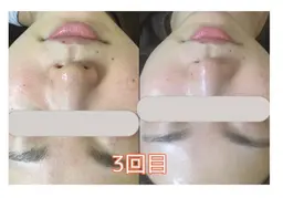 【海外セレブで人気爆発❤️】透明感ある毛穴レス卵肌に♪ハイドラフェイシャル✨