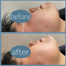 メンズ 顔全体脱毛 初回来店限定価格50%OFF