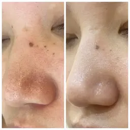 ダウンタイムなし！痛みなし！ハーブピーリング