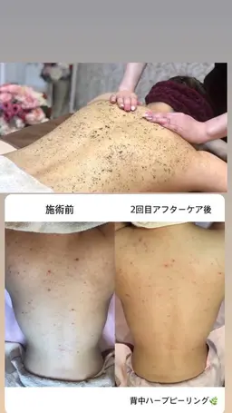 背中orお尻or二の腕　ハーブピーリング🌿鎮静パック付き💓 men's ➕1000円になります！