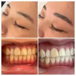 【今月限定3名様のみ】2点同時施術可能✨ホワイトニング+眉毛Wax脱毛🌹歯科医師監修の液剤