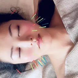 【小顔鍼40分】美容鍼&低周波+ドライヘッドスパ