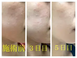 ニキビ撤退🌈ハーブピーリング✨60分