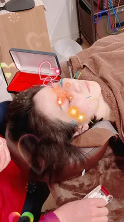 🌸【人気No.1】美容鍼