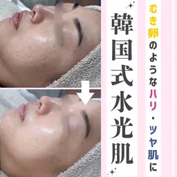 人気NO.1🤍〈ツヤツヤ水光肌〉水光肌ピーリング (剥離&ダウンタイムなし) 60分5,000円