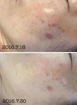 持続力No.1❗️❗️大人気✨小鼻、アゴザラザラとシミさよなら4回コース