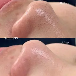 【毛穴洗浄】黒ずみ/開き毛穴/いちご鼻一発解消!!6800→5800