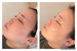 幹細胞にアプローチし、お肌を根本改善💖毛穴の開き、乾燥、ツヤ不足など一人一人の気になるお肌悩みを良い状態へ