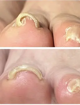 巻き爪ケア導入キャンペーン