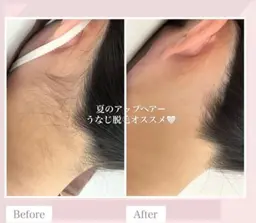 【うなじ脱毛＋デザインシェービング付】¥2000   ポニーテール/アップヘアに◎丁寧にデザインします😊
