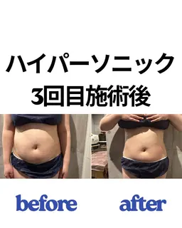 Body痩せ​〜​痩身​〜​最新マシンハイパーソニック！施術後の実感95%以上⭐︎コースなし、都度払い🉐衝撃の効果😳✨