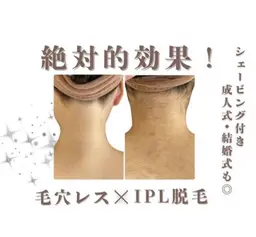 【最新機器導入】うなじ脱毛💫ー１０℃脱毛で痛みゼロ😮効果抜群✨とにかく抜ける新感覚❣️