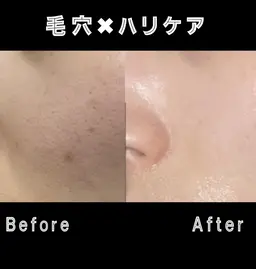 90%オフ❣️28​〜​31日限定毛穴レス全顔脱毛❣️シェービング付✨目指せ毛穴レス&ノーファンデ