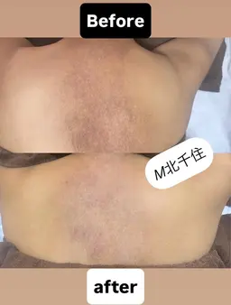 【ニキビや跡、毛公性苔癬でお悩みの方にも♪】剥離あり！ボディーハーブピーリング1箇所🌿※背中上部or下部or二の腕など