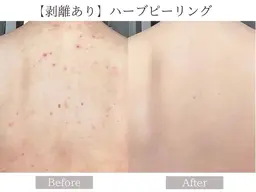 ♦️人気NO,2♦️【剥離ありハーブピーリング•ボディ】〈背中/二の腕/ヒップ/デコルテ対応〉すぐ実感!ハーブピーリング