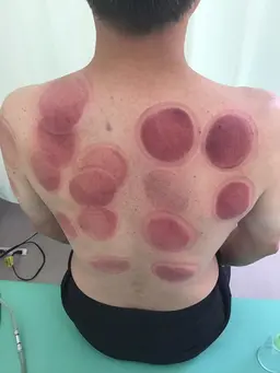 カッピング　全身