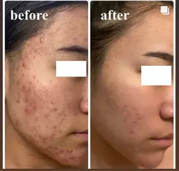 フェイシャルエステ