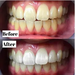 【⚜️チケット会員様⚜️】専用メニュー🦷✨ハイパワー4回照射