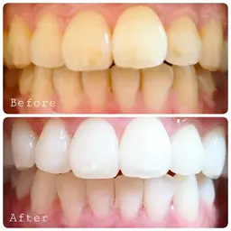 一番人気！セルフホワイトニング30分照射🦷着色汚れ、葉の黄ばみ、ワイン、タバコのご習慣のある方