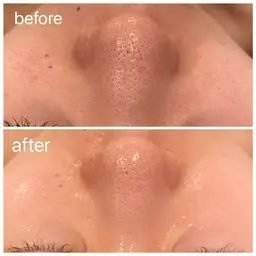 【お正月限定!🎍】剥離なしハーブピーリング🌿+REVIウォッシングクリームプレゼント🫧 ⚠️数量限定