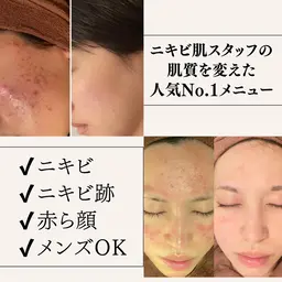 私の激荒れ肌はこれで改善した👀｜1日2組限定の当サロンオリジナル・ニキビ/ニキビ跡ケアコース👼✨