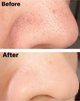 【毛穴の黒ずみ、角栓スッキリ！毛穴洗浄】水素水＆吸引で脱いちご鼻！ザラつき改善！ビタミンCパックで毛穴引き締め♪