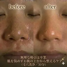 【学割U24】毛穴精密洗浄+美肌パック✨就活・イベント前の肌管理に◎(大阪/梅田)