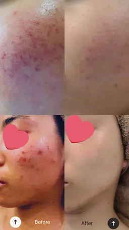 特許ハーブピーリングDTなし👶お顔も首もデコルテまで全範囲ツルピカ卵肌🐣♥️シルクパウダー付き🫧