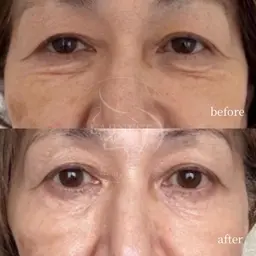 【目元ケア】切らないクマ取り・たるみ改善特化 ◆韓国IR管理 ¥5,500
