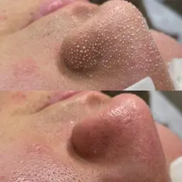 【毛穴汚れ・黒ずみが気になる方】ハイドラ毛穴洗浄🫧