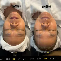 【シワ・たるみお悩み改善に✨】 筋肉にアプローチ💪🏻造形エステ(ショルダーマッサージ付)