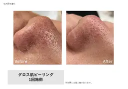 【いちご鼻改善】ハイドラピーリング🥚毛穴汚れ徹底洗浄🫧