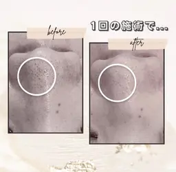 【モニター限定】鼻周りのみの集中毛穴洗浄☆施術前後の写真・動画撮影・ネット掲載OK・口コミの記入をして下さる方のみ。