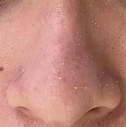 👃ブラックヘッド改善コース👃毛穴汚れ!酸化して黒くなっている毛穴へ自社開発の特別な美容液を使用して汚れを除去👀