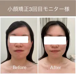小顔体験モニター✨ ¥1,100モニター♪《条件：全顔出し、ビフォーアフター翌朝の写真、口コミをしてくださる方限定❗️》