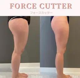 【ボディ】1台で4役の痩身効果◎美ボディマシン(1部位)