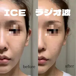 小顔！！リフトアップ！🧖‍♀️【ICEラジオフェイシャル40分】ハリツヤup※当日はお化粧をせずお越しください。
