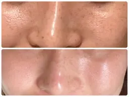 剥離なしREVIハーブピーリング（ニキビ肌、シミ、シワ）