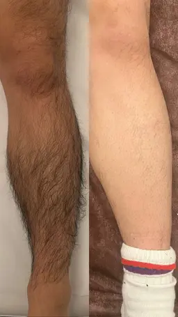 【全身脱毛】サロン選びに迷ってる方へ✨