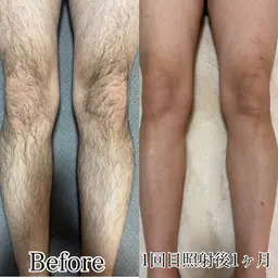 men'sひざ下・ひざ上脱毛