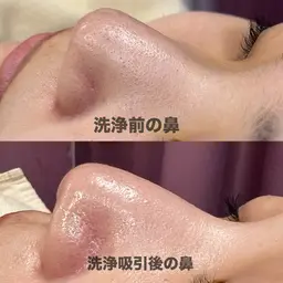 【🧼毛穴洗浄】顔剃り+小鼻洗浄+拭き取りパック✨