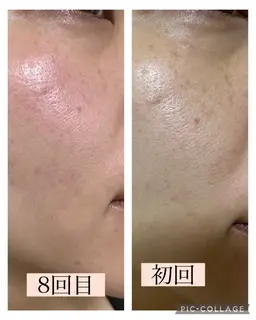 肌質改善モニターさん募集❗️1週間に1度、2ヶ月間集中的にエレクトロポレーション導入コース 自慢のツヤ肌作り